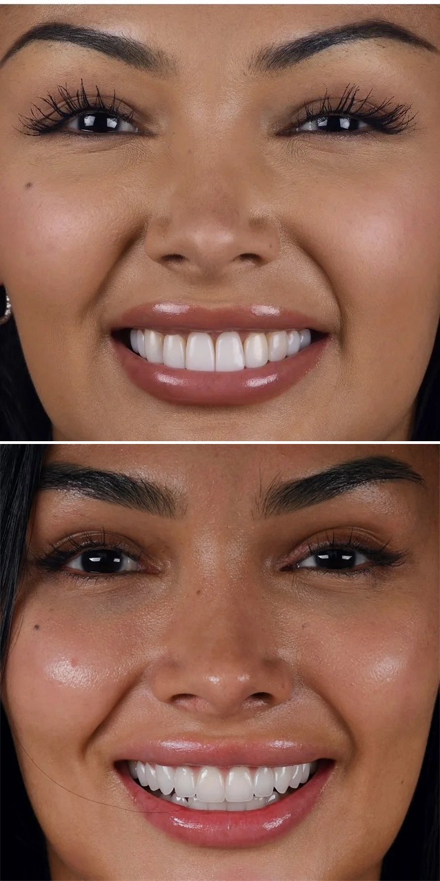 Full transformation: before treatment, the smile lacked brightness and balance; after treatment, a personalized cosmetic plan using custom porcelain restorations delivered luminous vitality and precise contouring in harmony with the patient's facial features.